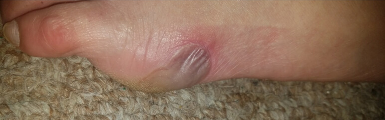 Diabetic Foot Ulcer/Blister