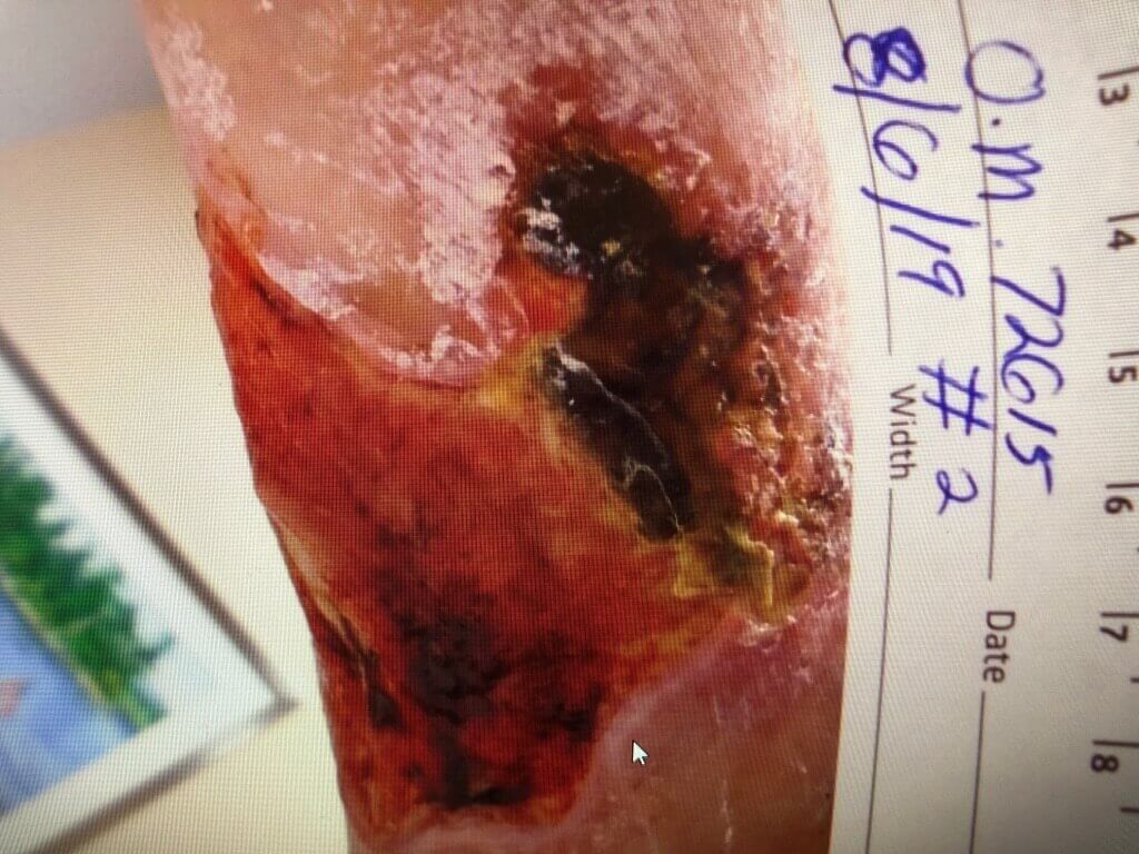 Venous Stasis Ulcer