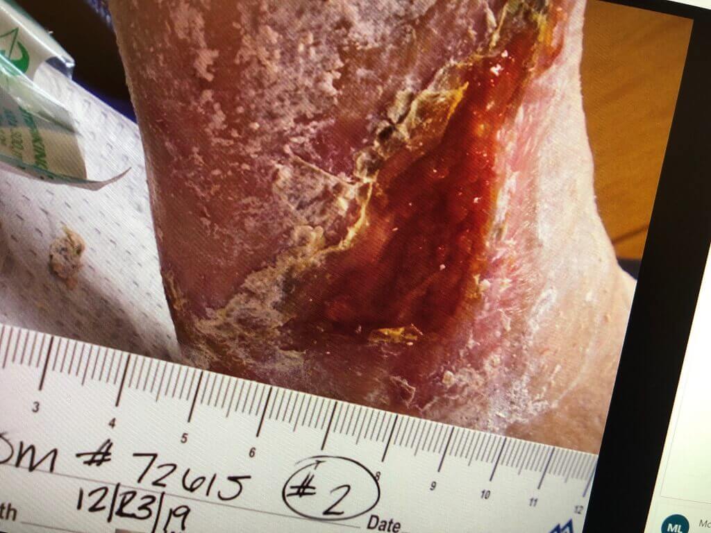 Venous Stasis Ulcer