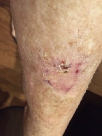 Failing Muscle Flap