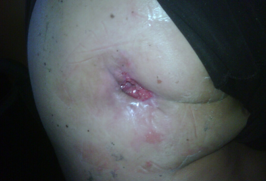 Pressure-Injury-Results