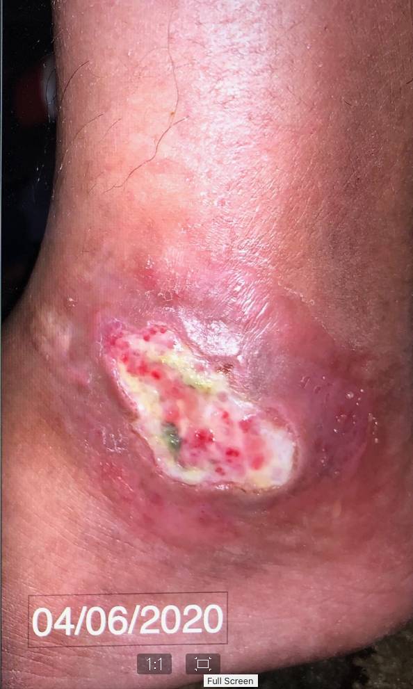 Raynaud’s & Scleroderma