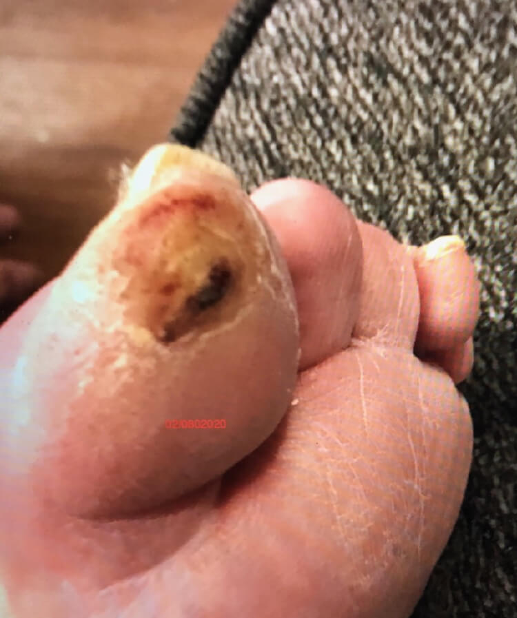 Diabetic Foot Ulcer/Hammertoe