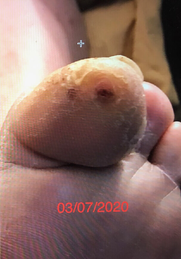 Diabetic Foot Ulcer/Hammertoe