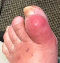 Diabetic Foot Ulcer/Hammertoe