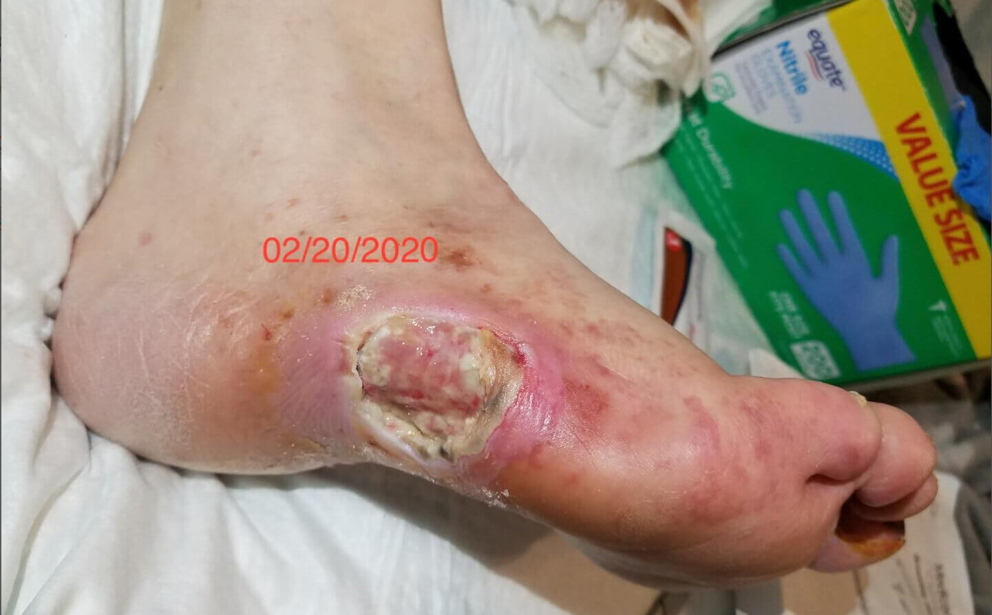 Diabetic Foot Ulcer/Chronic