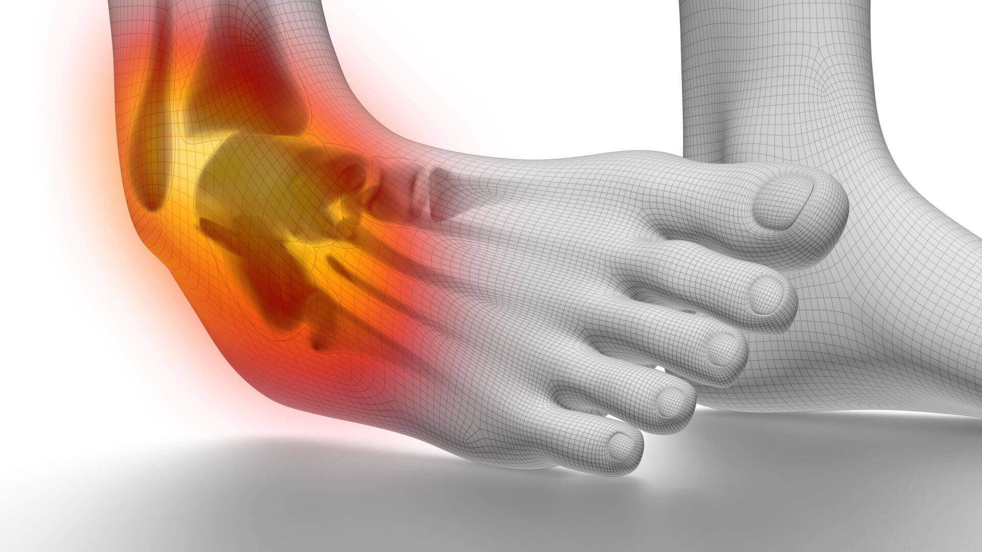 Sprained ankle