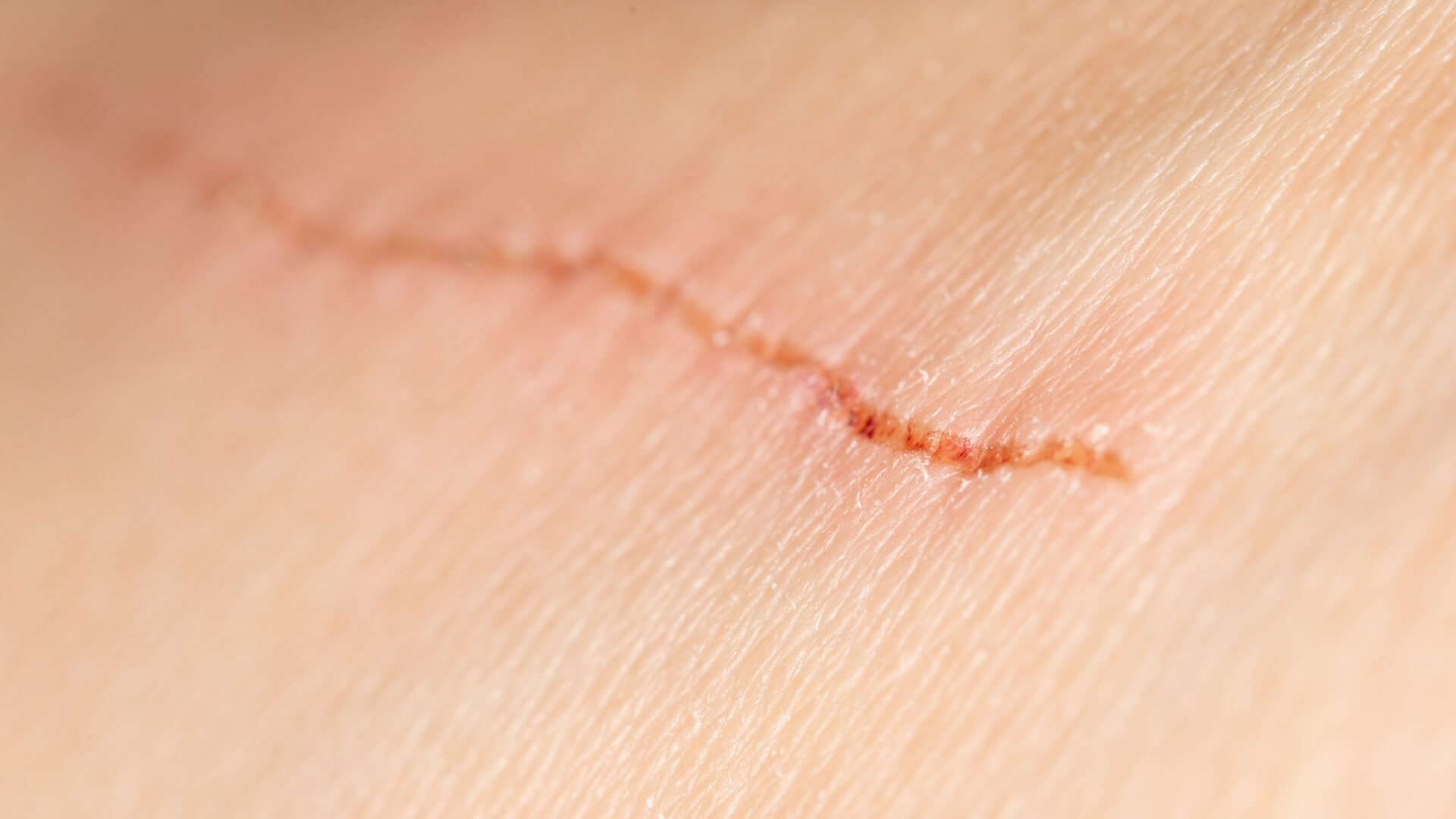 phases of skin healing